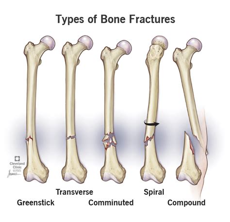 Shin Bone Bruise