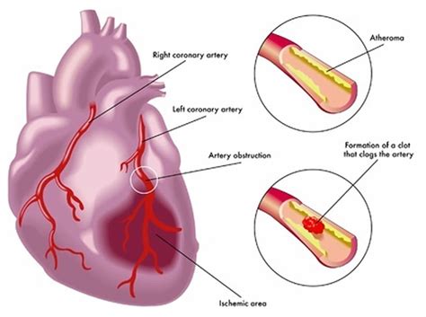 Wellens syndrome definition, diagnostic criteria, causes, symptoms ...