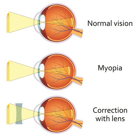 Myopia: Symptoms, Causes & Treatment | Kraff Eye Institute