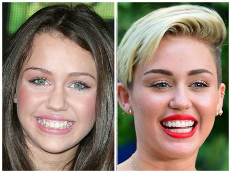 Celebrities with Veneers | My Porcelain Veneers