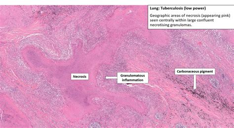 Tuberculosis Lungs Histology