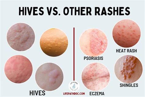 Hives (Urticaria) vs. Rash: Pictures and Differences