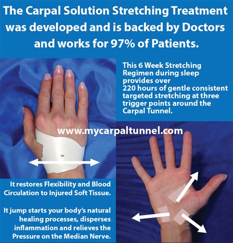 Carpal Tunnel Stretches – What Doctors Recommend - 97% Success Rate