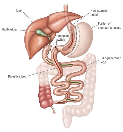 HANY TAKLA, MD, FACS, FASMBS, DABS-FPMBS — Duodenal Switch