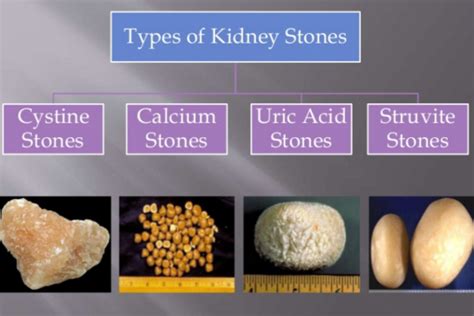 Cystine Kidney Stones