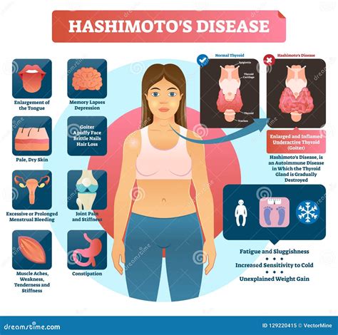 Hashimotos Thyroiditis Vector Illustration. Labeled Medical Diagram ...