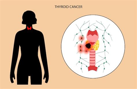 Premium Vector | Thyroid cancer stages