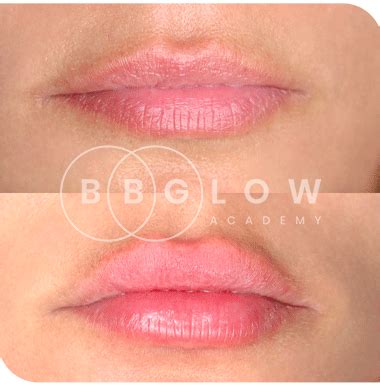 BB Glow Academy Hyaluronic lip filler training | BB Glow Academy | Get ...