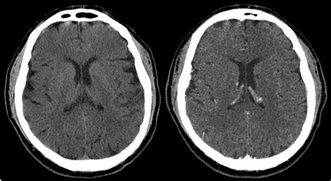 Gadolinium on CT - Questions and Answers in MRI