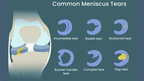 What is Torn Meniscus? Symptoms, Causes, and Treatment