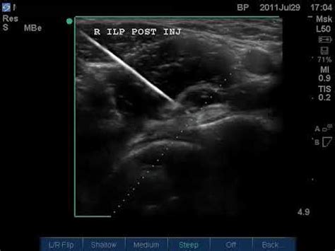 Technique For Ultrasound Guided Iliopsoas Bursa Injections After Total ...