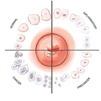 Abnormal Pap Smear Treatment | Best Gynecologists in NYC