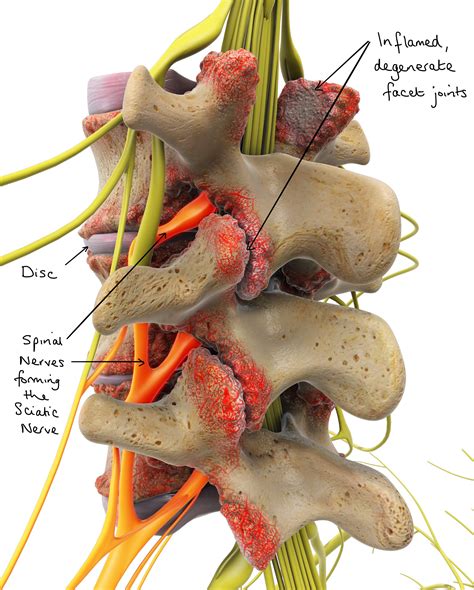 Facet Joint Disease - Spines Dorset