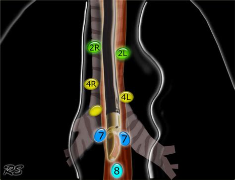 The Radiology Assistant : Mediastinum - Lymph Node Map