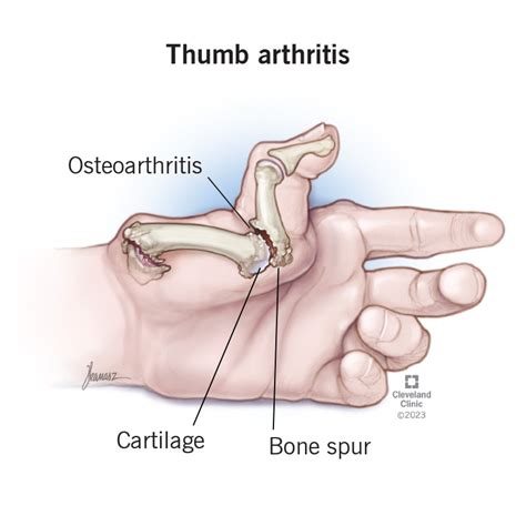 Thumb Arthritis: Symptoms, Diagnosis, Treatment & Prevention