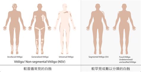 What is Vitiligo ? | Medical treatment and early prevention works