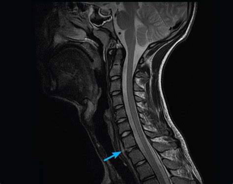 Adult MRI Series - Cervical spine: Trauma