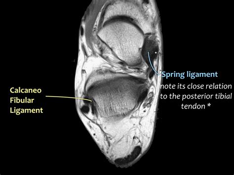 The Radiology Assistant : Ankle - MRI examination