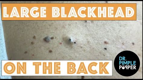 Dr Pimple Popper Massive Blackheads 2021