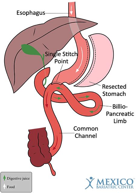 Single Anastomosis Duodenal Switch - Obesity Reporter