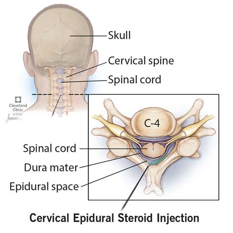 Cervical Epidural Steroid Injections: What It Is, Benefits, Risks ...