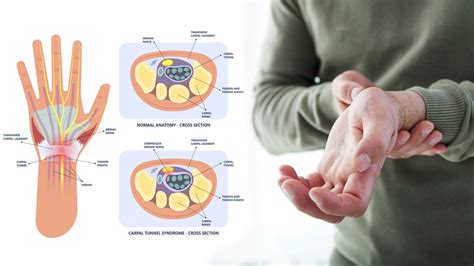 6 Wrist Exercises to Relieve Carpal Tunnel Pain