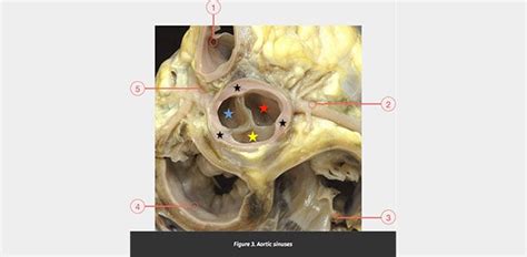 Aortic sinuses