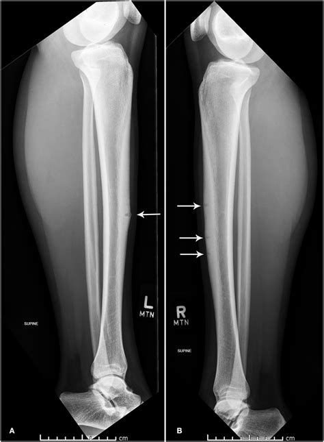 | Lateral x-ray of left (A) and right (B) tibia and fibula. | Download ...