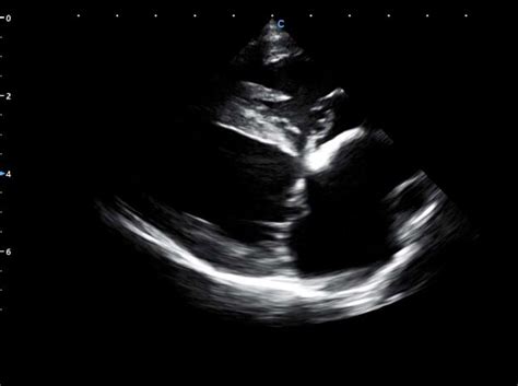 Animal Case Sharing | Myxomatous Mitral Valve Disease in Canine