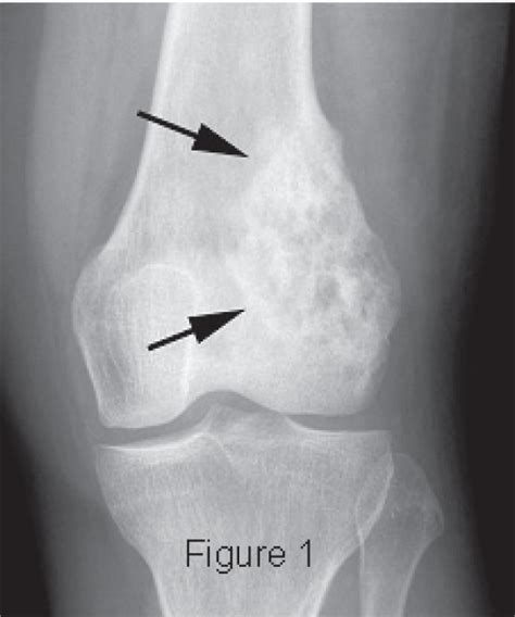 Osteosarcoma X Ray