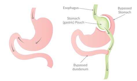 Loop Duodenal Switch (SADI-S) Surgery Cape Girardeau MO