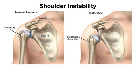 Shoulder Instability: Symptoms, Causes, Treatment By Shoulder Braces