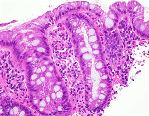 Barrett's Esophagus Histology