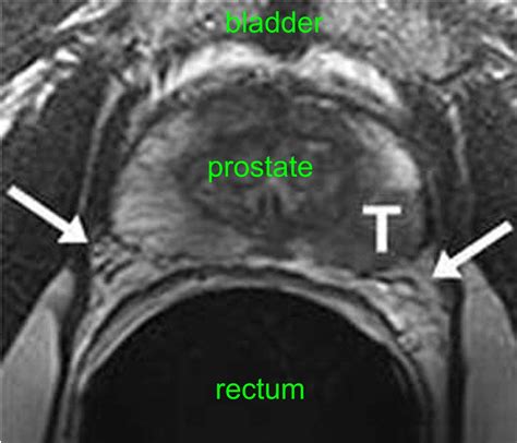 Prostate MRI Scan