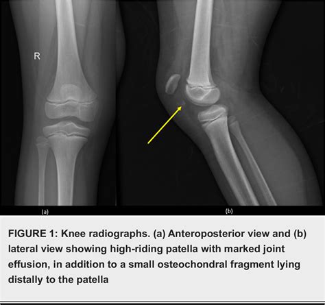 Figure 1 from Patellar Sleeve Fracture in an Eight-Year-Old Girl ...