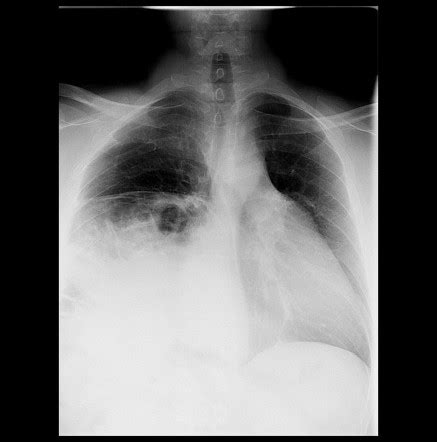 Phrenic Nerve Palsy