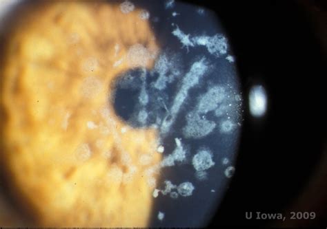 Macular Corneal Dystrophy