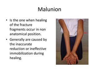 Bone healing | PPT