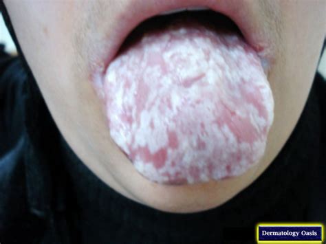 Oral Candidiasis (Thrush) | Dermatology Oasis