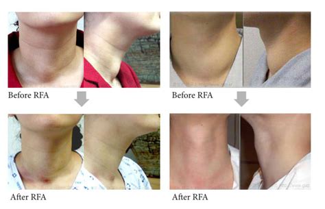 Thyroid No Surgery 101: Thyroid Nodule Radiofrequency Ablation Study ...