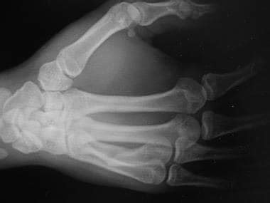 Malunion of Hand Fracture Treatment & Management: Approach ...