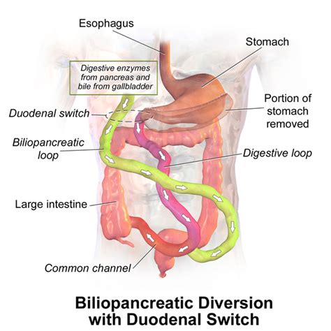 Duodenal Switch Surgery - Longstreet Center for Weight Management