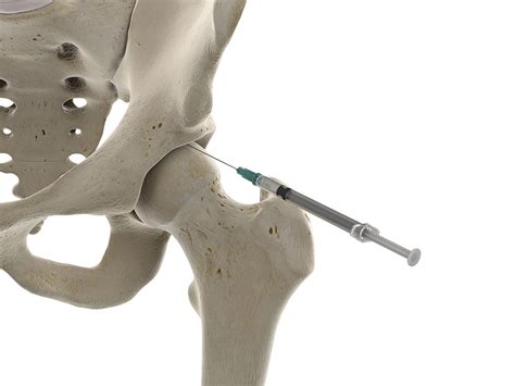 Intra-Articular Hip Injection | Excel Pain and Spine