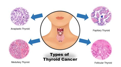 Thyroid Cancer: Symptoms, Types, Causes And Treatment Overview