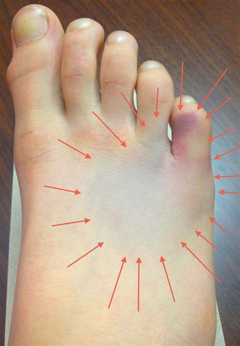 My Running Doc: How Can I Tell if My Foot is Broken?