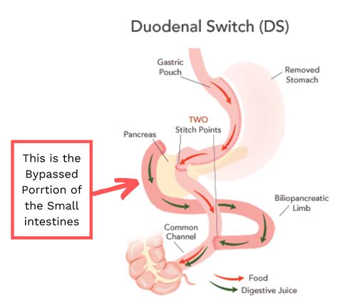 Duodenal Switch Weight Loss Surgery Procedure | Blog Dandk