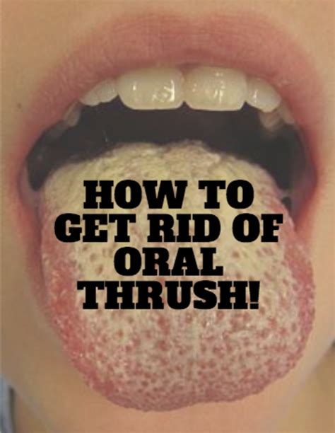 Oral Thrush