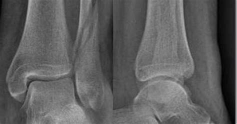 ABC Radiology Blog: Weber B ankle fracture