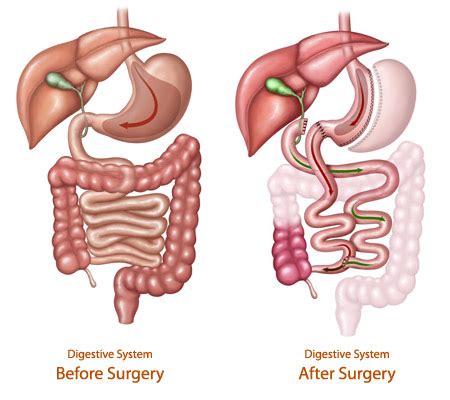 Duodenal Switch Surgery: Advantages, Disadvantages & Cost » How To Relief