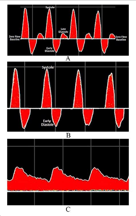 Triphasic (A), biphasic (B), and monophasic (C) Doppler waveforms ...